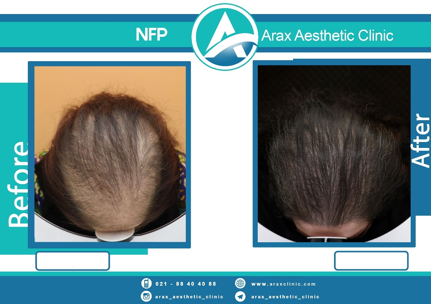 روش NFP برای درمان قطعی ریزش مو در ایران اجرا شد