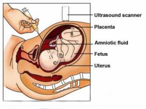 amniocentesis-3