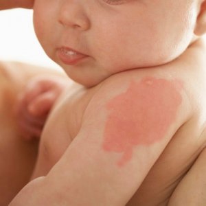 baby-with-birthmark-photo-420x420-ts-200353913-001
