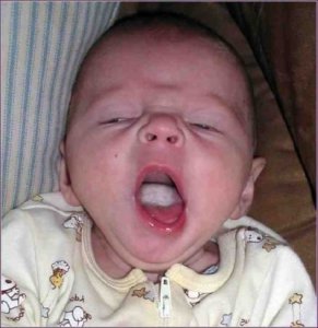 oral-thrush-baby-pictures