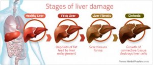 stages-of-liver32-damage-520x221