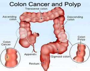 colon-cancer-gh0272