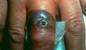 cutaneous_anthrax_infection