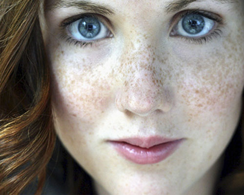 tips How To Get Rid Of Freckles