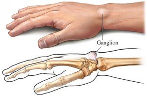 ganglion-cyst