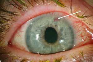 eye-disease-glaucoma