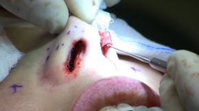 surgery-rhinoplasty-290x163