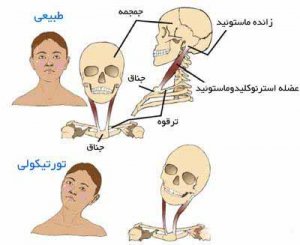 تورتیکولی-یا-کجی-گردن-نوزاد