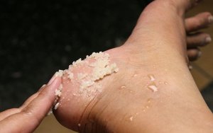 Simple remedies for cracked heel 1-3