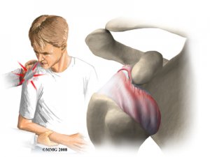 shoulder_dislocation