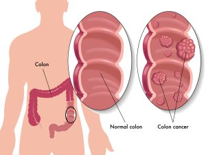 Stage-4-colon-cancer-survival-rate