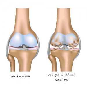 osteoarthritis-knee-joint