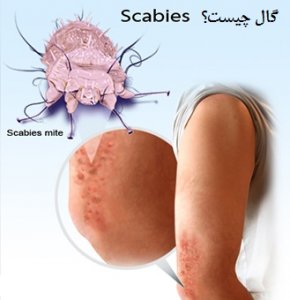 scabies-2