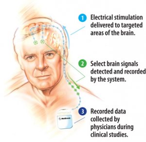 deep-brain-stimulation-for-parkinsons-disease2