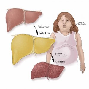 graphic-fatty-liver