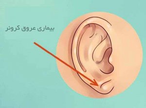 تشخیص برخی از بیماری از روی گوش