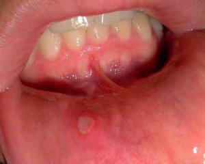 بروز مشکلات دهان با این 5 علائم
