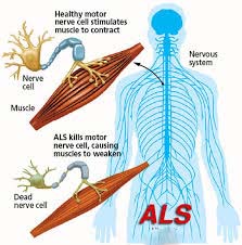 آنچه درباره بیماری ALS  و علائم آن نمیدانید