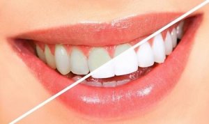 هشدار درباره عوارض پودر سفیدکننده دندان