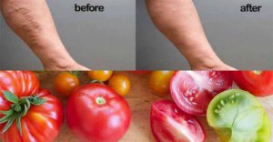 رابطه درمان گوجه فرنگی با رگ های واریسی