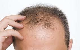 ریزش موی مردان با کمبود هورمون جنسی مردانه ارتباط ندارد