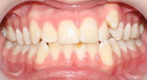دانستنی هایی در مورد افرادی که دندان نیش کج دارند