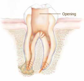 راهکاری برای درمان ریشه دندان بدون درد