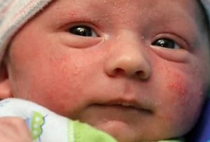شیوه درمان جوش های صورت نوزاد