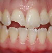 دانستنی های درباره شکستگی دندان