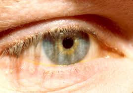 دلایل بروز لکه های زرد در چشم چیست