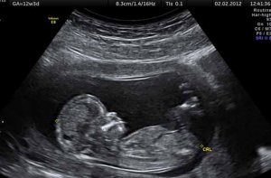 در دوران حاملگی چند بار سونوگرافی مفید است