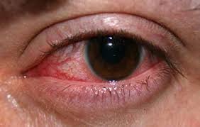 هشدار هایی درباره خطرات عفونت بعد جراحی چشم