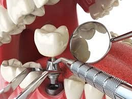 روش کاشت دندان ایمپلنت