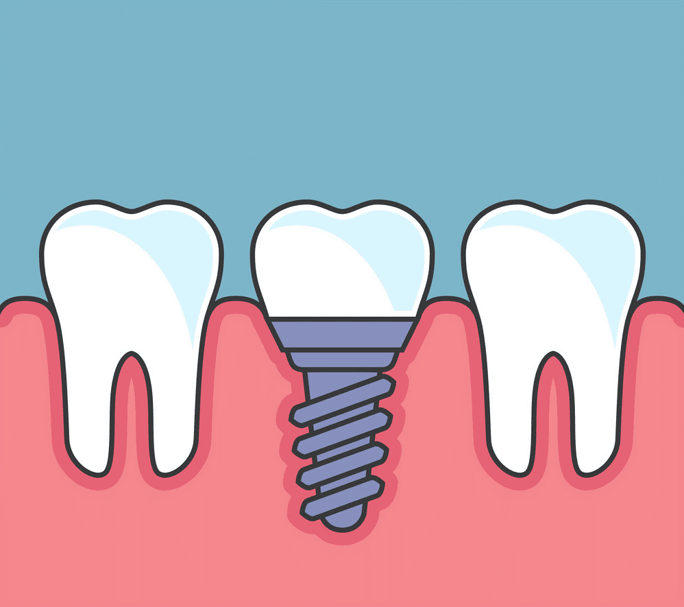 ایمپلنت دندان چیست ؟