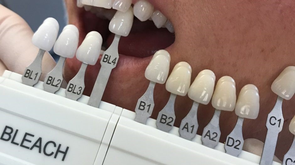 قیمت لمینت دندان چقدر است؟ لمینت به صرفه تر است یا کامپوزیت؟