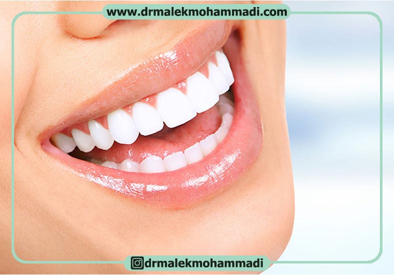 کاربرد لمینیت دندان چیست؟