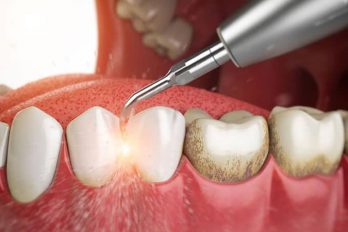 آیا جرم گیری باعث لق شدن دندان ها می شود؟