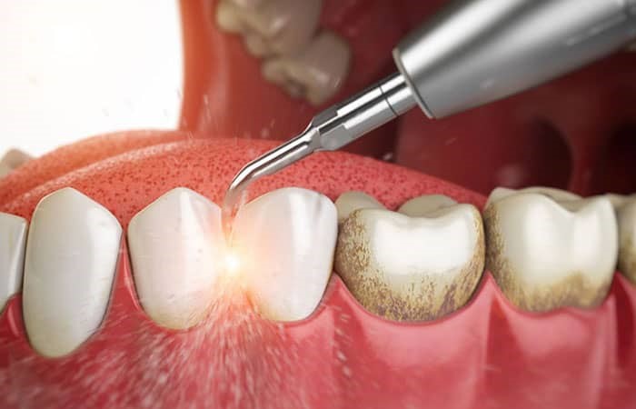آیا جرم گیری باعث لق شدن دندان ها می شود؟
