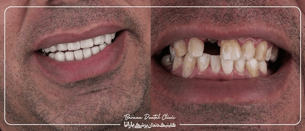 عکس قبل و بعد ایمپلنت دندان آلمانی