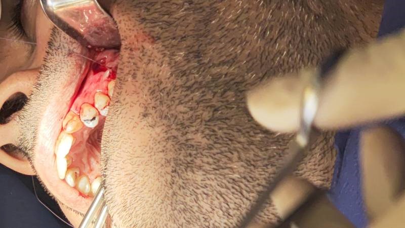 آیا بدن ایمپلنت دندان را پس می زند؟